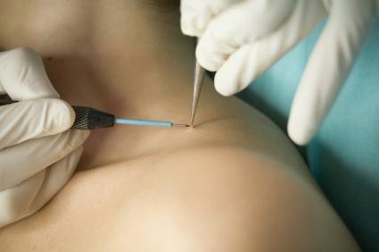 Skin Tag Removal Perth